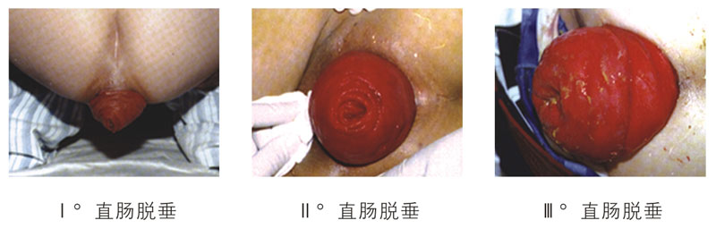 福州肛门脱肛医院哪家好？